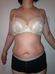 お客様の声　施術後前面写真