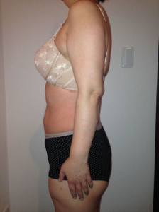 お客様の声　施術後側面画像